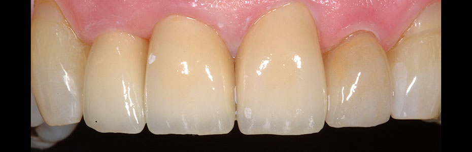 Mit vollkeramischer Lösung